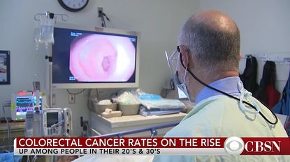 Colorectal cancer is on the rise for people in 20s and 30s