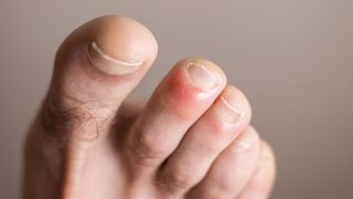 toes with chilblains