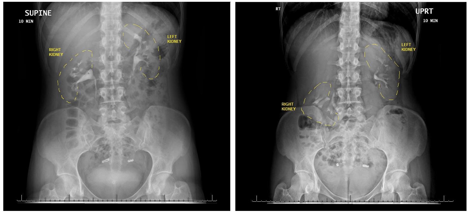 this-woman-s-kidney-fell-into-her-pelvis-whenever-she-stood-up-here-s