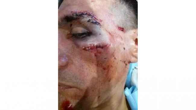 Paolo Tiralongo's facial injuries after his stage two crash at the Vuelta