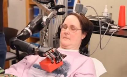 Woman's Bionic Hand Controlled by Brain