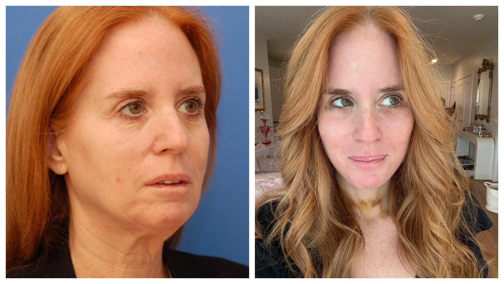 Jenny Hutt before and after her facelift.