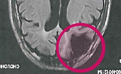 Cecil Clayton's brain scan.