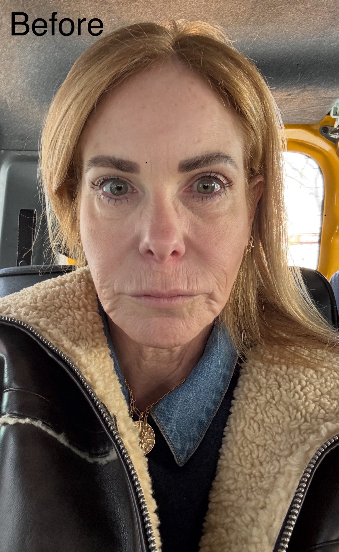 before photo of facelift and blepharoplasty