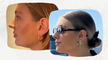 beauty editor rebecca fearn pictured before and after having exion treatment with a more defined and sharp jawline in the after picture
