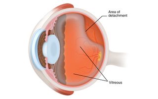 A diagram shows the jellylike vitreous humor partly detached from the back wall of the eye.