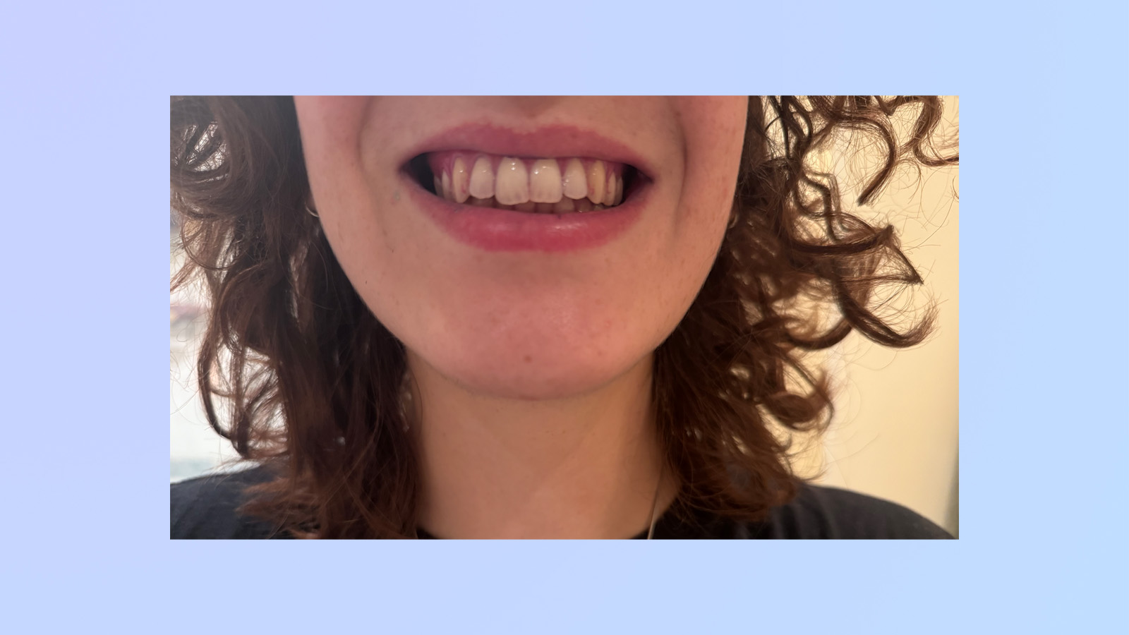 a photograph of the author's teeth before using the suri 2.0 brush
