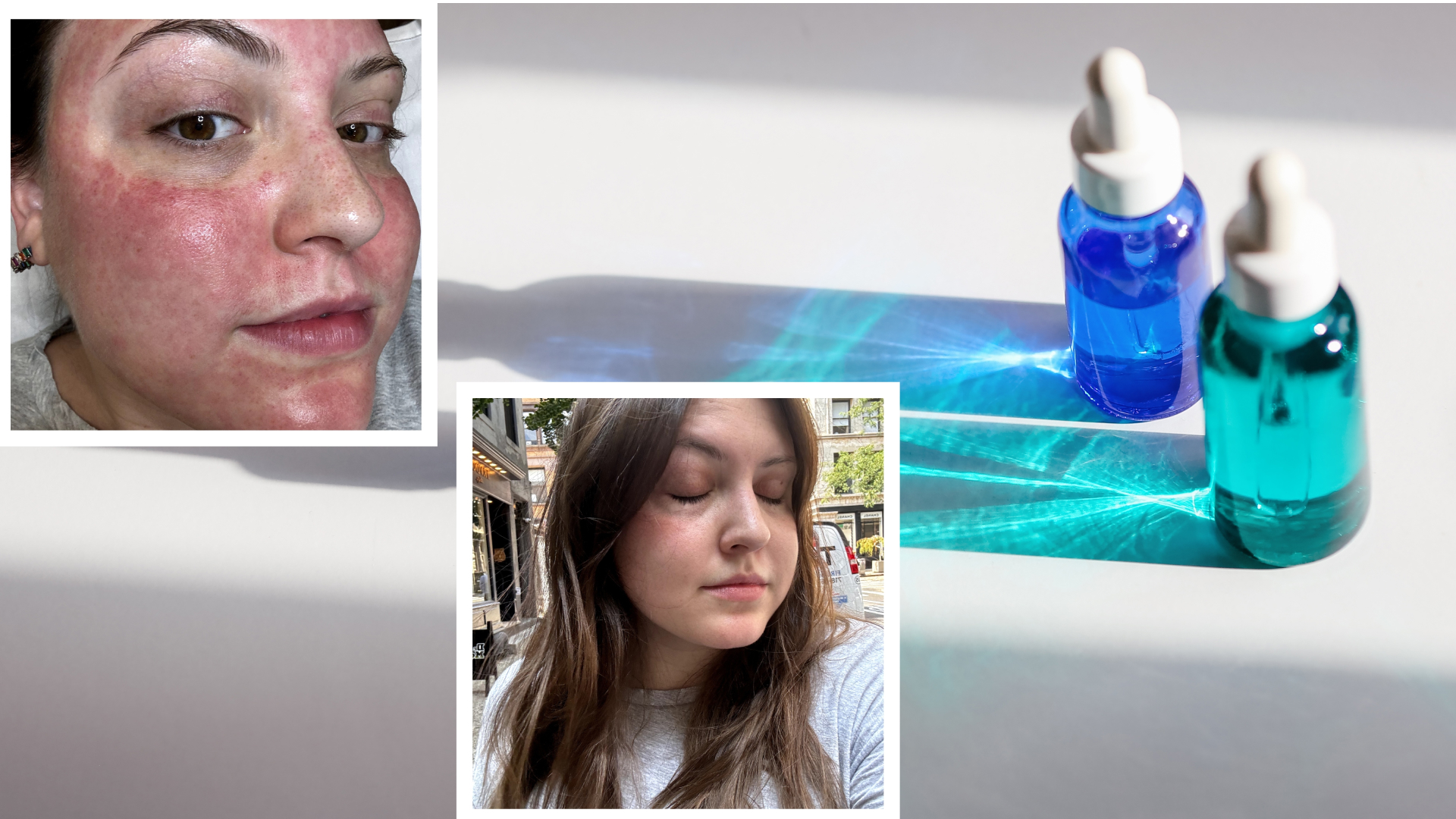 Freelance beauty writer Sophia Vilensky&#039;s skin after a microneedling and exosome treatment at Haus Salon in Minneapolis.