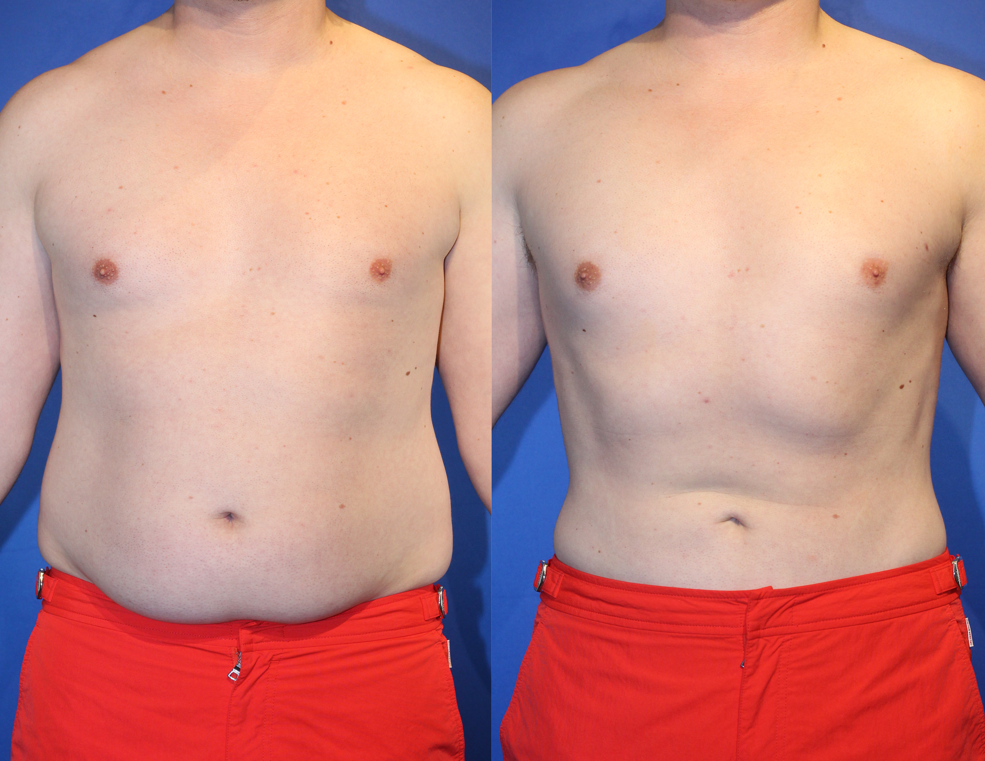 before and after lean lipo, a man with orange shorts cropped from the shoulders down