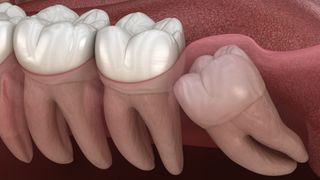 Can wisdom teeth grow back? Illustration of impacted wisdom tooth