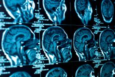 Stock photo of brain CT scan.