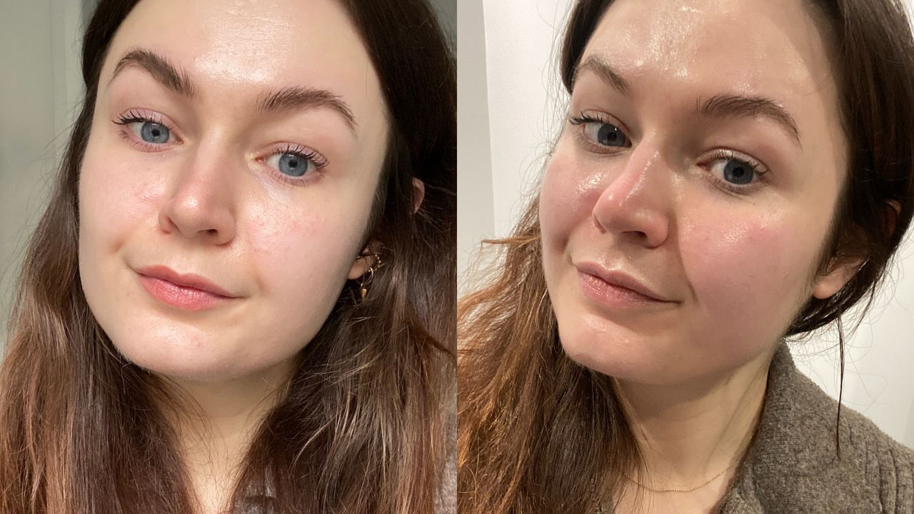 Collage of two images showing Lucy&#039;s skin before and after the Hydrafacial