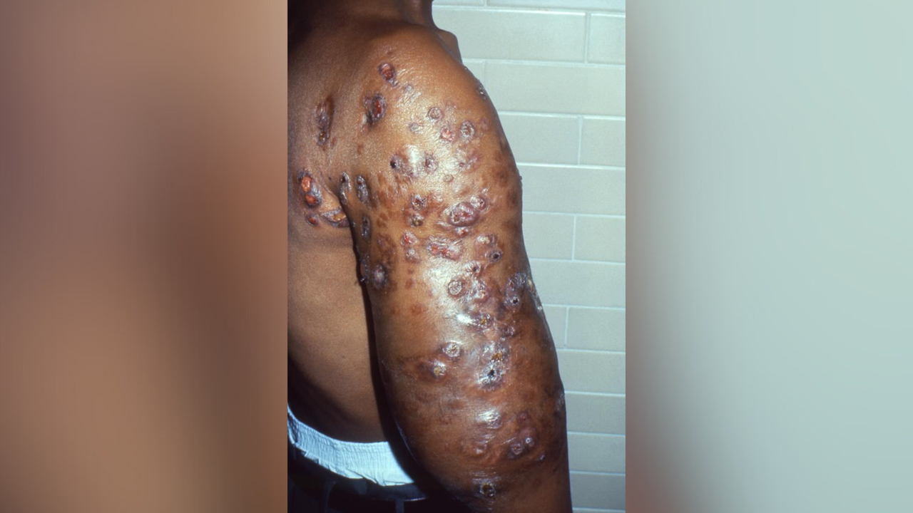 A picture of the upper arm of a patient with nocardiosis. Their arm is covered in skin ulcers.