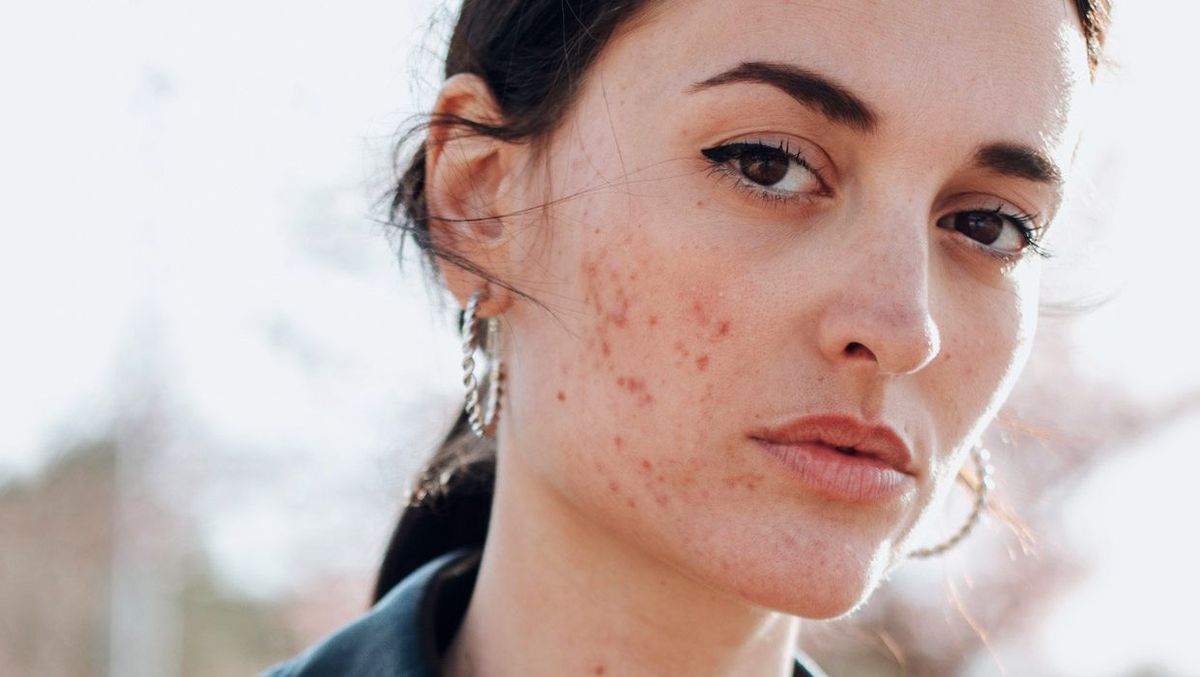 Are Your Cosmetics Inflicting Your Zits?