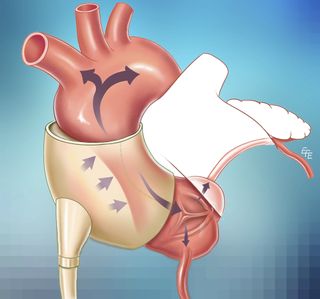 heart, cardiac, C-pulse system graphic
