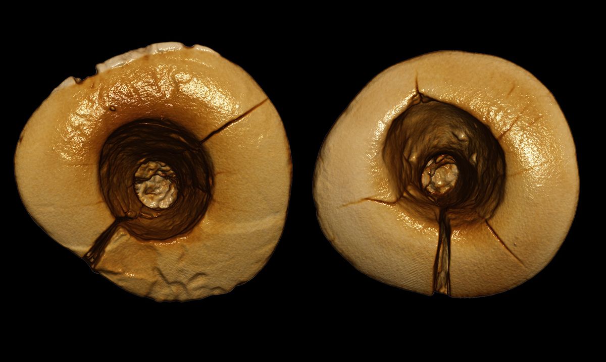 Archaeologists discovered a 13,000-year-old skeleton with two front teeth that have big holes in the surface that reach down to the tooth&#039;s pulp chamber.