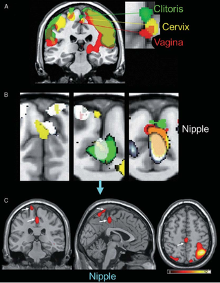 Researchers at Rutgers University have mapped the brain areas in women that respond to stimulation of the genitals. The top of the image shows how the clitoris, cervix and vagina send nerve impulses to the same area in the medial paracentral lobule of the brain. This spot sits at the top of the head in the crevice between the two halves of the brain. Although the nipples are nowhere near the genitals, touching them lights up the same part of the brain as touching the genitals. That might be why many women find nipple stimulation erotic, researchers reported July 28 in the Journal of Sexual Medicine.