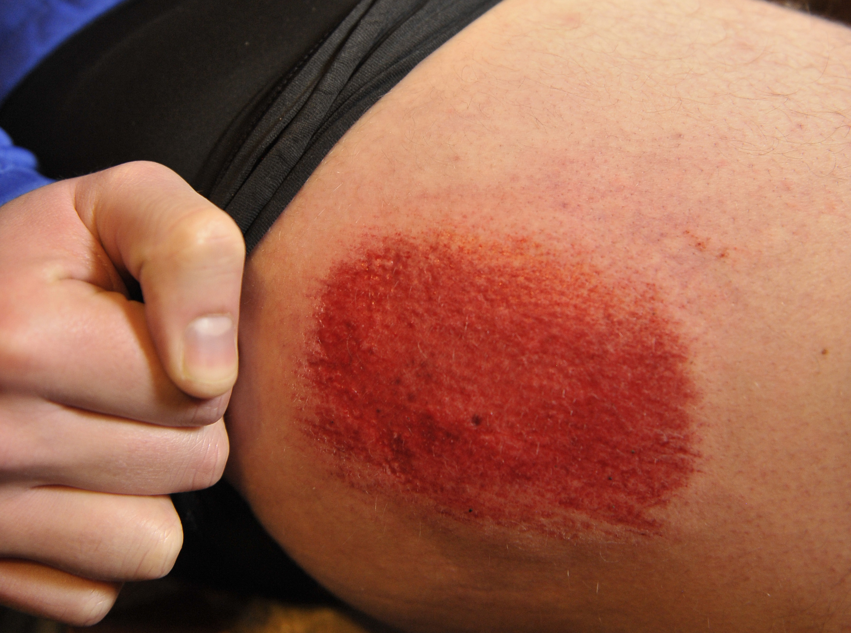 Cyclists road rash