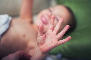 Hand, foot and mouth disease sores