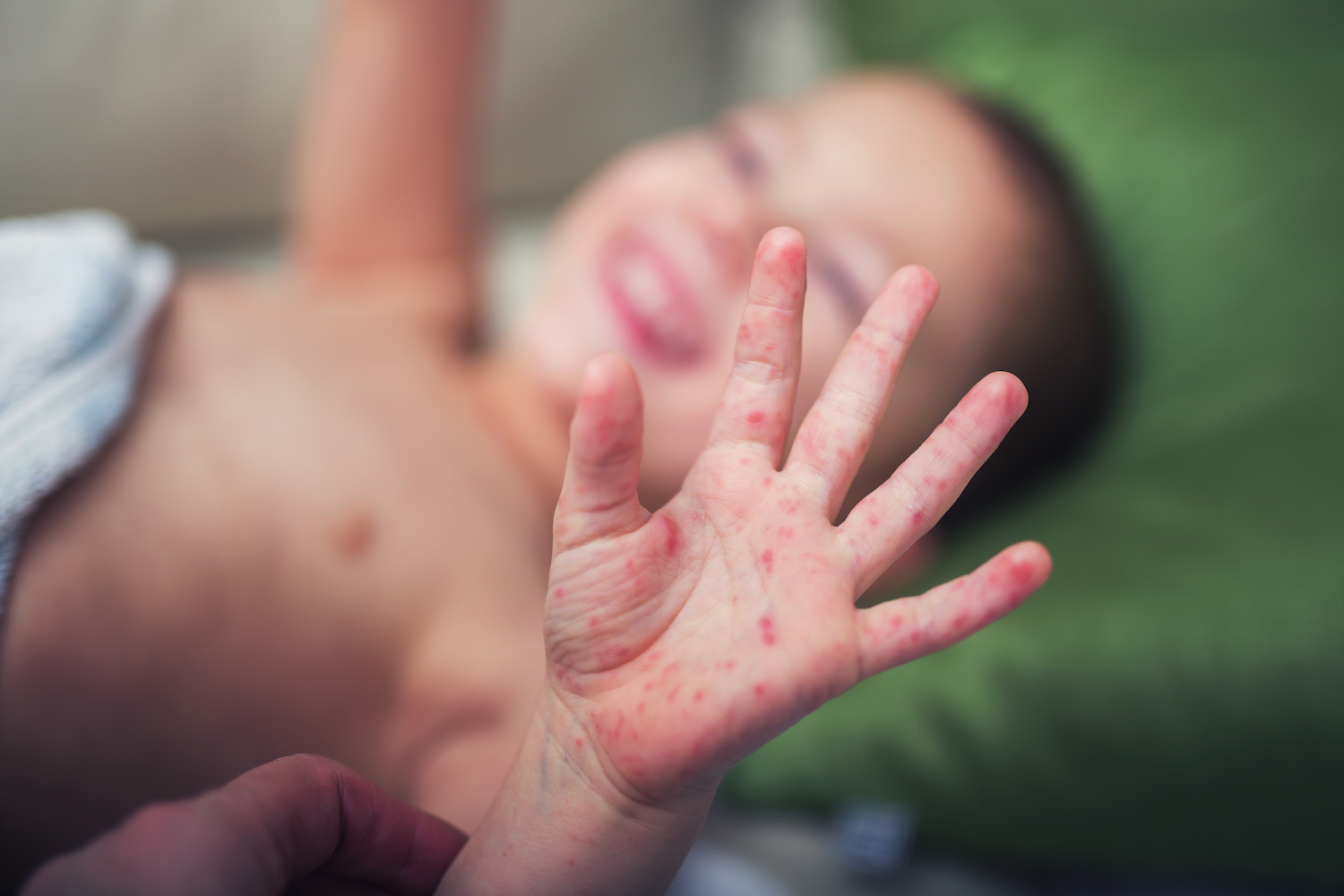 Hand, Foot and Mouth Disease: Causes, Symptoms and Treatment | Live Science