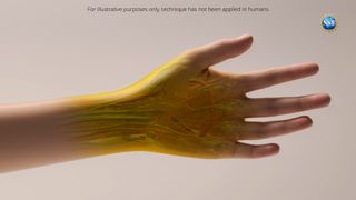 Medical illustration showing a close-up of a person&#039;s arm and hand with the palm facing towards the viewer, against a beige-colored background. Some of the hand is shown in yellow and blood vessels are visible. 