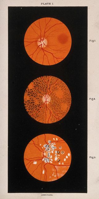 Lithograph of the eye through a microscope