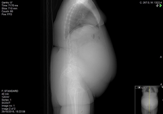 A CT scan showing the cyst within the woman's abdomen.