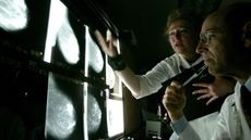 Doctors look at films of breast cancer X-rays