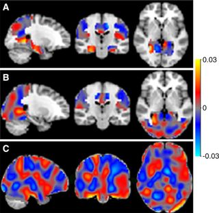 In these brain scans, the classifiers can be represented as discrimination maps, where a red color indicates that the intensity at that location contributes to the likelihood of the images belonging to the more advanced stage, and a blue color to the likelihood of belonging to the less advanced stage.