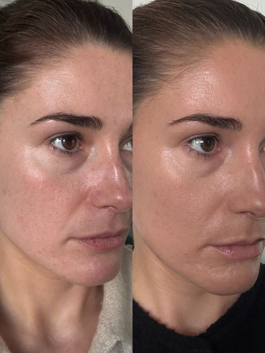 Antes y después de los ojos y las cejas 3 meses después de recibir un tratamiento Sofwave.