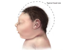 Microcephaly Chart