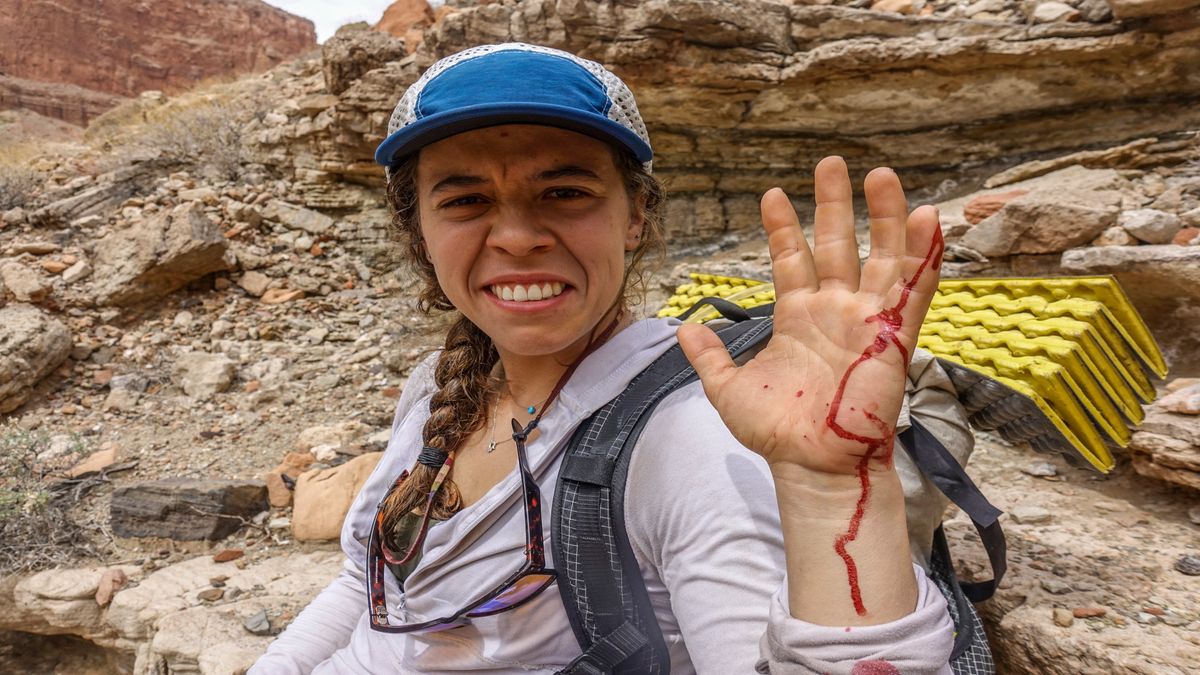 Hiking injuries and ailments how to avoid and treat them Advnture