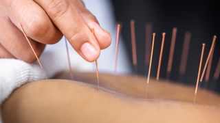close up of acupuncture