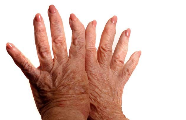 early osteoarthritis hands