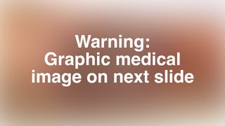 Necrotizing fasciitis: The 'flesh-eating' infection that bores holes in ...