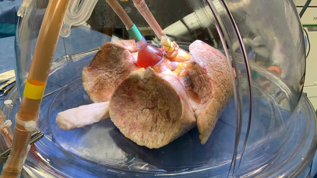 photo of a donated human lung in a machine that keeps the tissue alive outside of the body