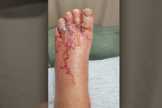 A photo of Eddie Zytner's foot after he became infected with hookworms.