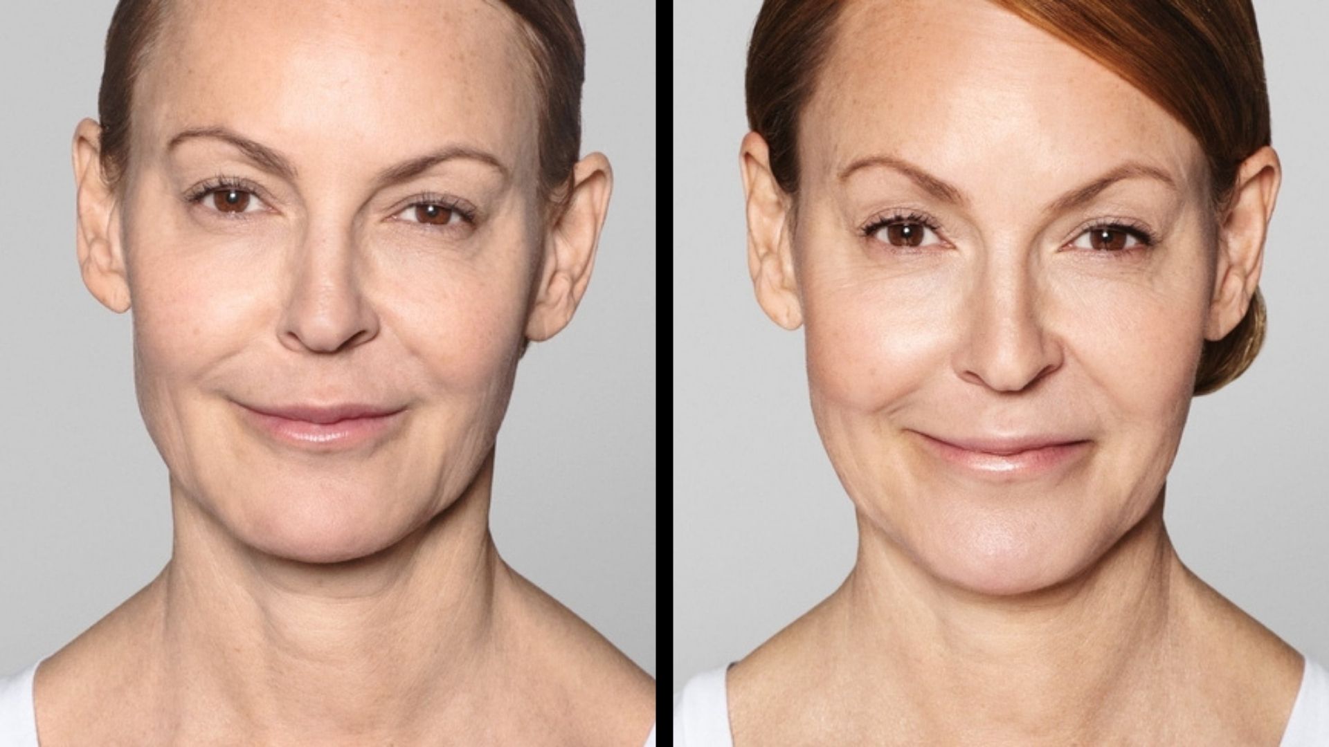 Galderma Restylane Skinboosters before and after