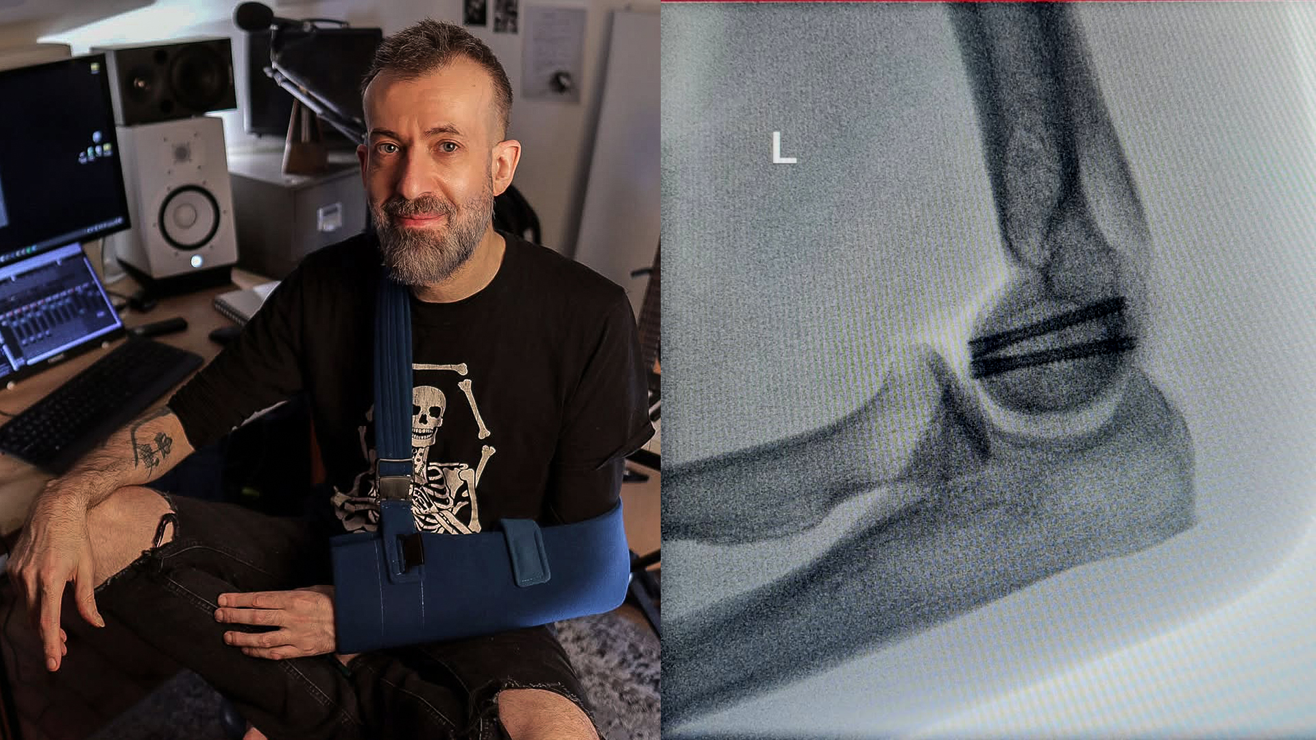 Jon Gomm poses wearing a cast on his left arm after a fall from stage that broke his humerus on February 5, 2026. The right side of the image is an x-ray showing the break