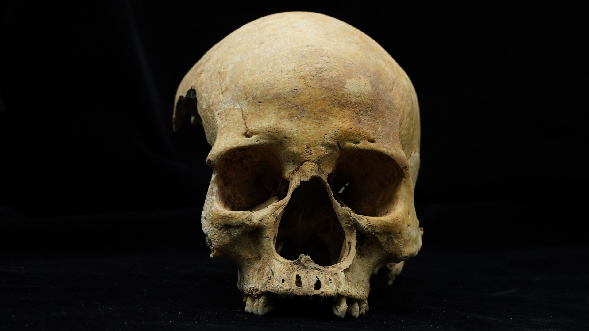 14th-century woman in China lost her nose to amputation — likely as punishment for stealing or adultery 14th-century woman in China lost her nose to amputation — likely as punishment for stealing or adultery