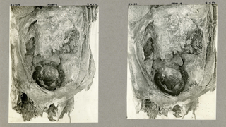 Two photographs show the mummy's incised abdomen and the fetus' head lodged in the pelvic cavity.