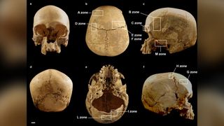Different views of the Neolithic woman's skull. The boxes indicate areas with lesions on the exterior of the skull.