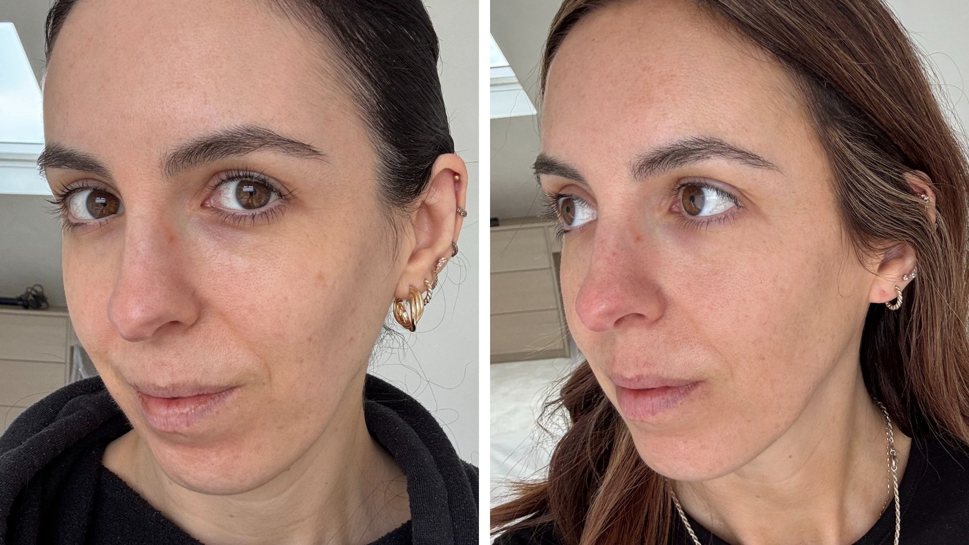 before and after of Stephanie Maylor using the Lyma for four months as part of her lyma laser review