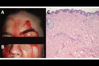 An image of the woman's face during a blood-sweat episode next to a magnified image of the woman's skin, which looked normal.