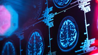 image shows a brain scan to detect neurological decline