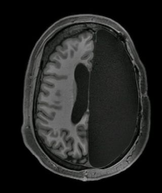 This fMRI scan depicts a cross-section of the brain of an adult who had an entire hemisphere removed.