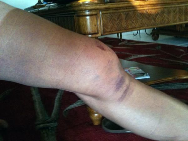 Ryan Trebon's injured left knee, two days after a pre-race crash at Sunday's USGP Derby City Cup.