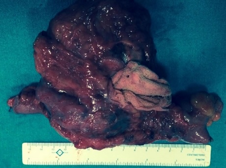 a picture of a large cyst that formed around a sponge. The cyst has been removed and is on a table next to a ruler for scale