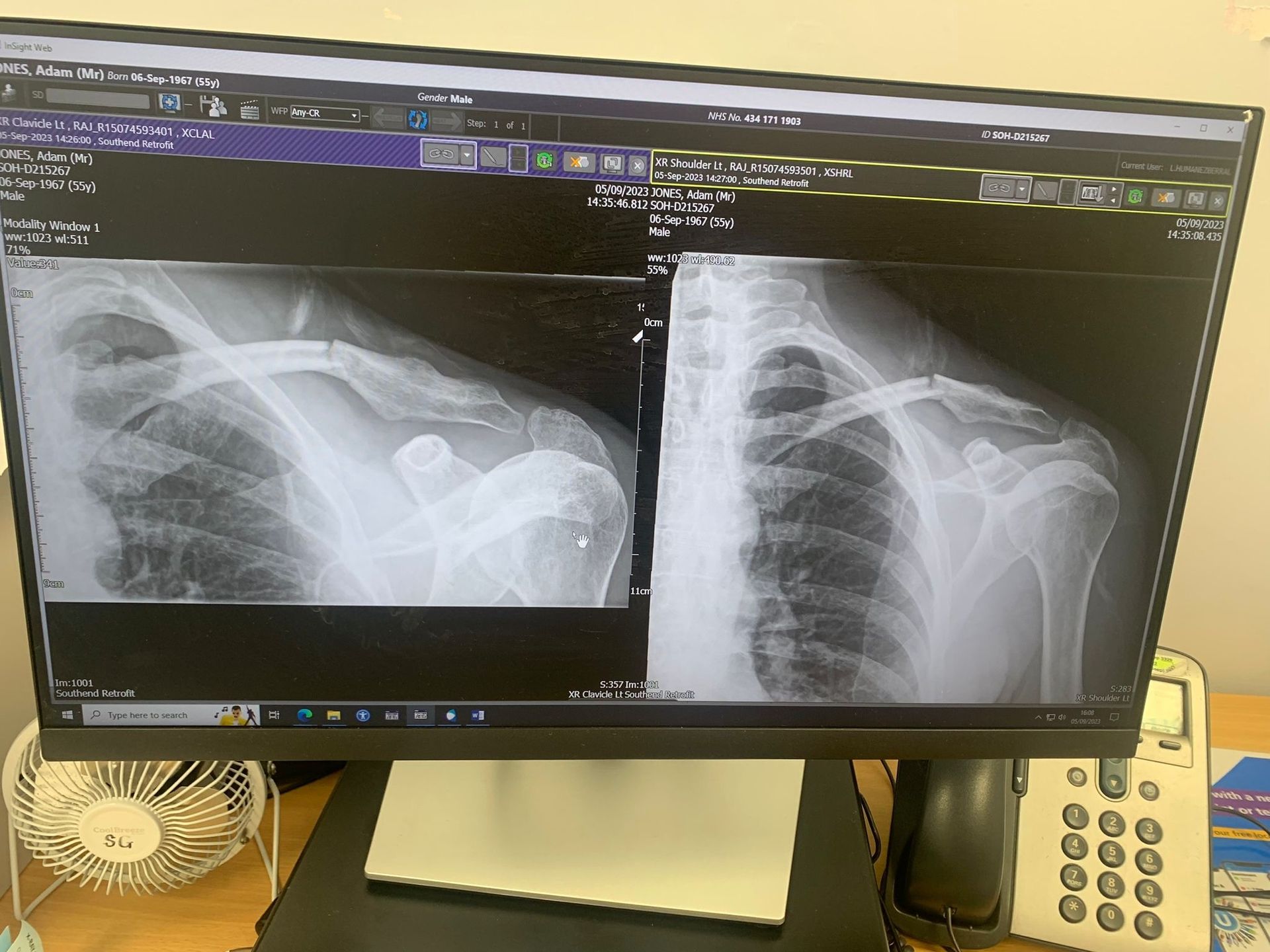 The new fracture can be seen with the callusing from the 2019 crash, to the right