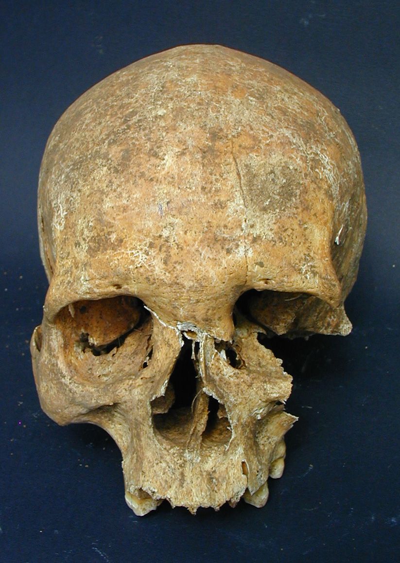 skeletons found on medieval battlefields